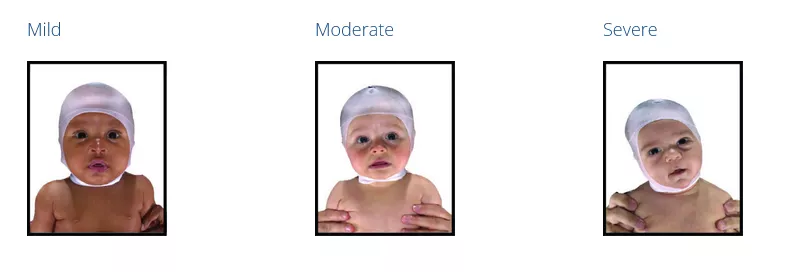 Torticollis ranging from mild to severe
